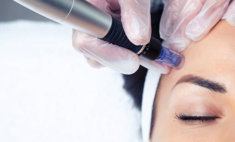How Often Should You Get A Microneedling Treatment